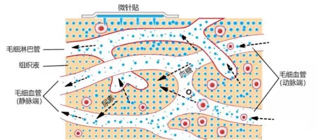 微针贴敷过程示意